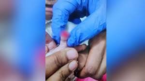 Bengaluru: 6-month-old's finger severed while removing dressing